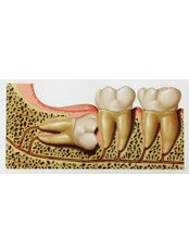 Wisdom Tooth Extraction - Dra. Luz Marely García Alvarez