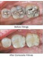 Fillings - Eagle Dental Clinic (extreme makeovers)