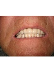 Dental Bridges - Eagle Dental Clinic (extreme makeovers)