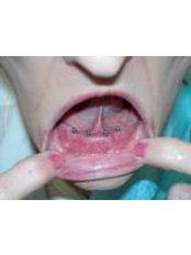Mini Implants - Eagle Dental Clinic (extreme makeovers)