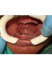 Implant Bridge - Eagle Dental Clinic (extreme makeovers)