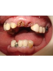 Dental Bridges - Eagle Dental Clinic (extreme makeovers)
