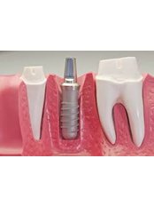 Dental Implants - Miguel Márquez Dental Clinic