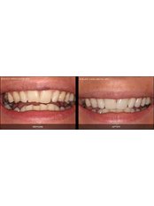 Dental Bonding - Miguel Márquez Dental Clinic