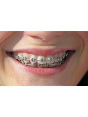 Metal Braces - Miguel Márquez Dental Clinic