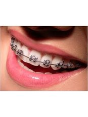 Braces - Miguel Márquez Dental Clinic