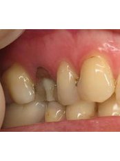 Premolar Root Canal - Miguel Márquez Dental Clinic