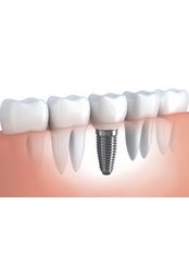 Dental Implants - Miguel Márquez Dental Clinic
