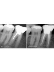 Molar Root Canal - Miguel Márquez Dental Clinic