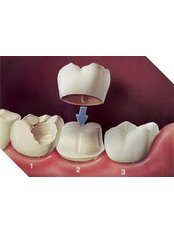 Dental Crowns - Miguel Márquez Dental Clinic