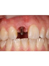 Restoration of Implants - Miguel Márquez Dental Clinic