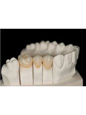 CAD/CAM Dental Restorations - Miguel Márquez Dental Clinic