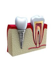 Single Implant - Miguel Márquez Dental Clinic