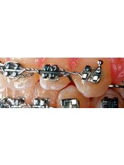 Braces - Miguel Márquez Dental Clinic
