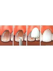 Porcelain Veneers - Miguel Márquez Dental Clinic