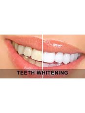 Teeth Whitening - Miguel Márquez Dental Clinic