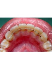 Orthodontic Retainer - Miguel Márquez Dental Clinic