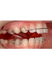 Clear Braces - Miguel Márquez Dental Clinic