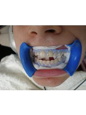 Teeth Whitening - Munoz Dental Care