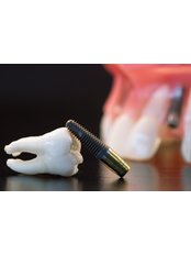 Implant Bridge - Munoz Dental Care