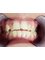 Platinum Dental Care - before invisalign 