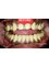Platinum Dental Care - before zirconia crowns 