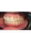 Platinum Dental Care - after invisalign 