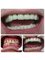 Progreso Smile Dental Center - PFM crowns 