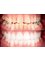 Progreso Smile Dental Center - Porcelain veneers before/after 