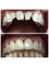 Progreso Smile Dental Center - 3 metal porcelain crowns on anterior teeth 