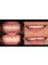 Progreso Smile Dental Center - Porcelain Veneers after/before 