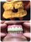 Progreso Smile Dental Center - Before and after of Emax bridges top and bottom 