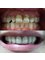 Progreso Smile Dental Center - Veneers and crowns 