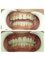 Progreso Smile Dental Center - Before and after of top front teeth with Veneers 