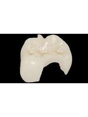 Inlay or Onlay - Dental Bio Esthetics