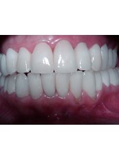 Dental Crowns - Dental Bio Esthetics