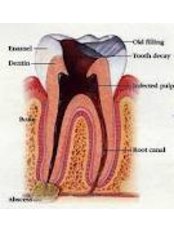 Root canals - Dental Bio Esthetics