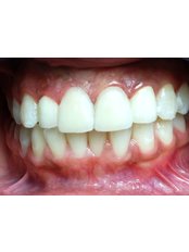 Zirconia Crown - Dental Bio Esthetics