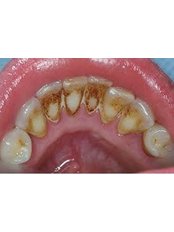 Ultrasonic Scaling - Dental Bio Esthetics