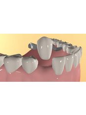 Maryland Bridge - Dental Bio Esthetics