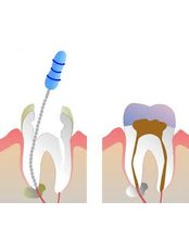 Root canals - Dental Bio Esthetics