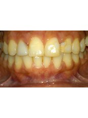 Zirconia Crown - Dental Bio Esthetics