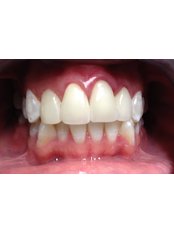 CAD/CAM Dental Restorations - Dental Bio Esthetics