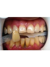Teeth Whitening - Dental Bio Esthetics