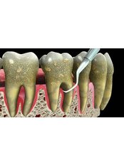 Scaling and Root Planing - Dental Bio Esthetics
