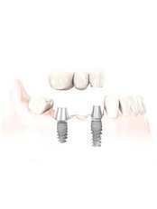 Implant Bridge - Dental Bio Esthetics