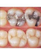 Fillings - Dental Bio Esthetics