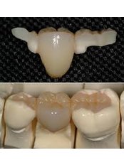 Dental Bridges - Dental Bio Esthetics