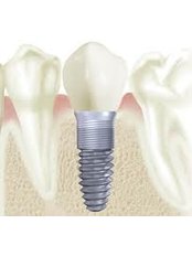 Implant Bridge - Dental Bio Esthetics