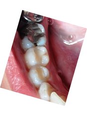 Fillings - Dental Bio Esthetics